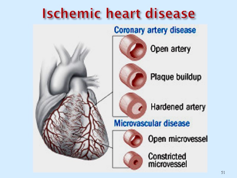 Ischemic heart disease 51